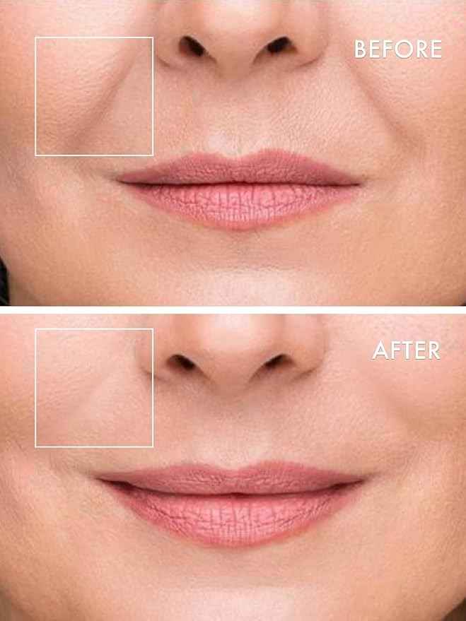 Microneedle Undereye Patches®